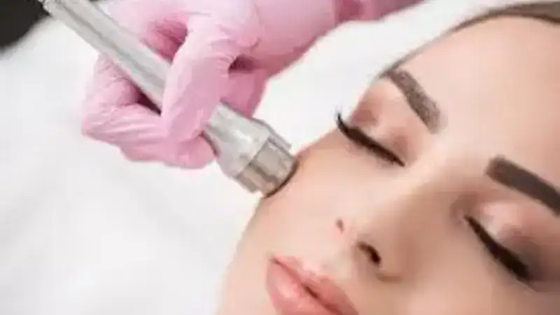 Getting Microdermabrasion